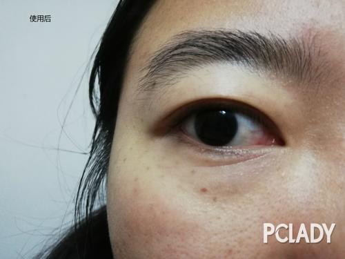 眼疥子图片大全,常见眼部寄生虫的识别与防治