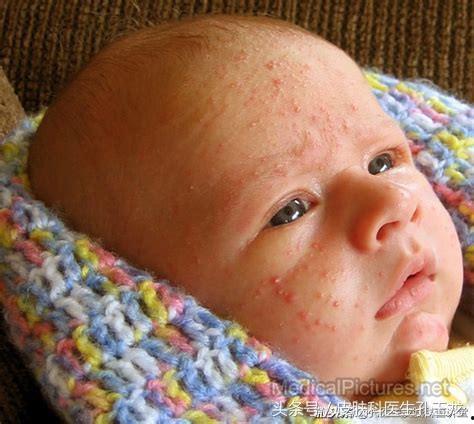湿疹婴儿图片大全,图片解析常见症状及应对方法