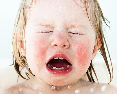湿疹婴儿图片大全,图片解析常见症状及应对方法