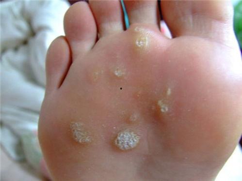 跖疣图片大全,全面了解跖疣特征与防治方法