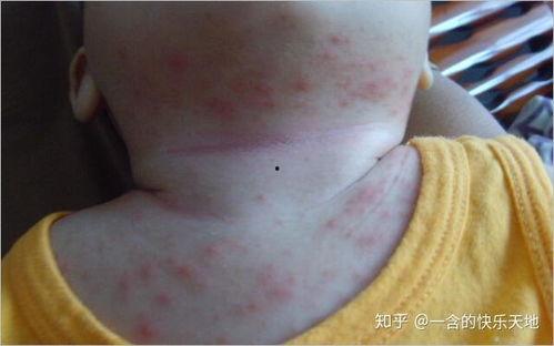 痱子和湿疹的区别图片,视觉对比解析