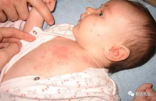 痱子和湿疹的区别图片,视觉对比解析